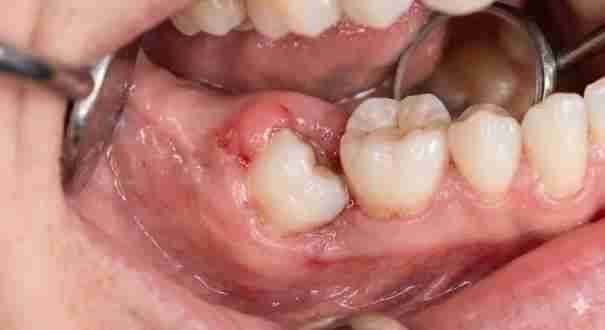 Wisdom tooth removal full guide
