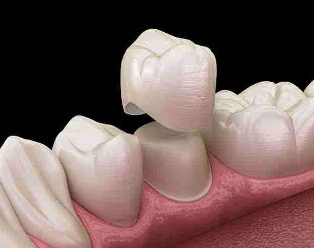 How long does a Dental Crown last? complete guide explained