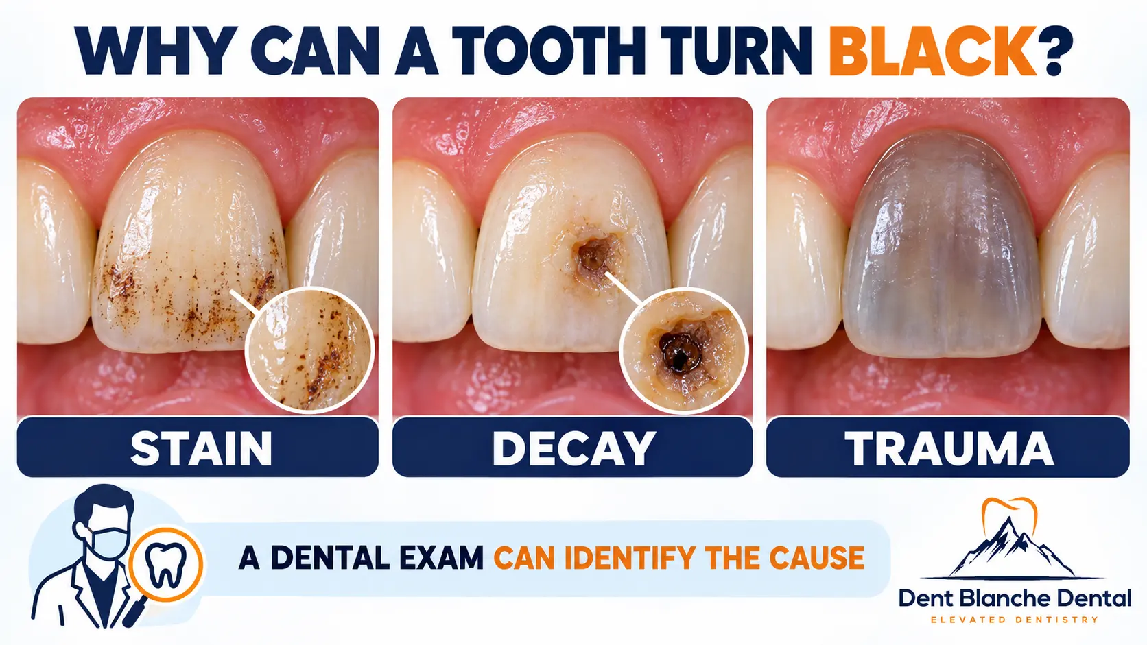 Comparison showing external tooth staining, dental decay and trauma as possible reasons a tooth may turn black.