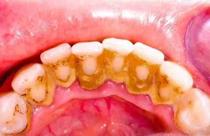Plaque Vs Tartar, difference and how to clean it full guide