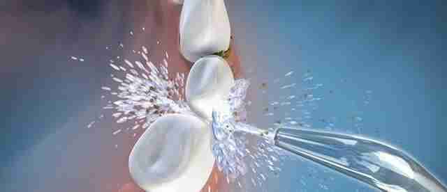 Tooth Filling how much full guide